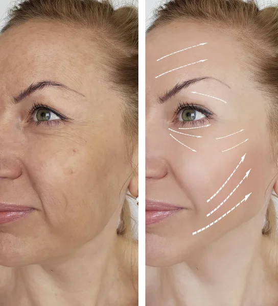 Woman Wrinkles Face Procedures — Stock Photo, Image