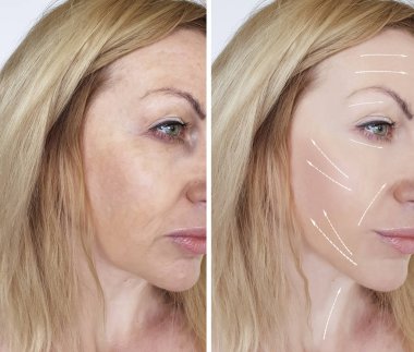 kadın kırışıklıkları yüz öncesi ve sonrası yordamları