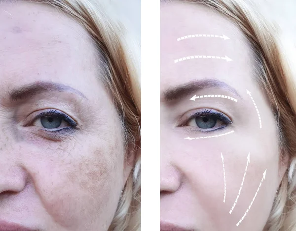 kadın kırışıklıkları yüz öncesi ve sonrası yordamları