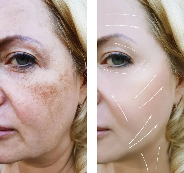 Γυναίκα Πρόσωπο Ρυτίδες Πριν Και Μετά Από Διαδικασίες — Φωτογραφία Αρχείου