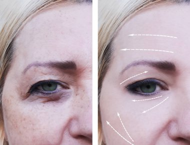 kadın yüz kırışıklıkları öncesi ve sonrası yordamları