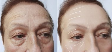 Yaşlı kadın kırışıklıklar yüzünde öncesi ve sonrası yordamları