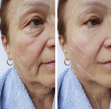 Yaşlı kadın kırışıklıklar yüzünde öncesi ve sonrası yordamları