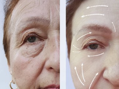 Yaşlı bir kadının yüz kırışıklıklar önce ve sonra yordamları