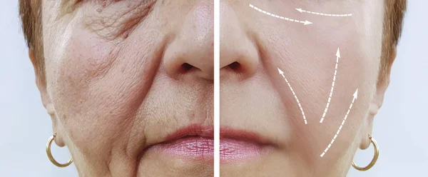 Face Old Woman Wrinkles Procedures — Stock Photo, Image