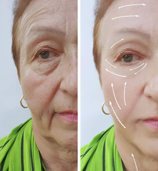 Face Old Woman Wrinkles Procedures — Stock Photo, Image