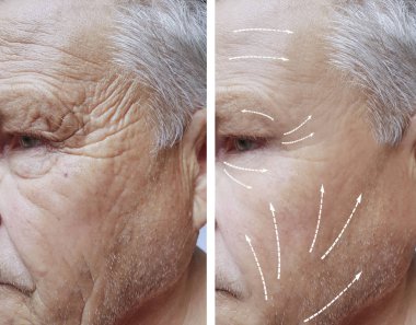 Yaşlı adam yüz kırışıklıkları öncesi ve sonrası yordamları ile