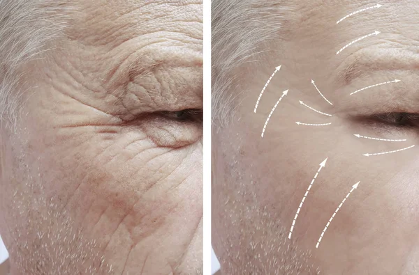 Παλιά Άνθρωπος Πρόσωπο Ρυτίδες Πριν Και Μετά Από Διαδικασίες — Φωτογραφία Αρχείου
