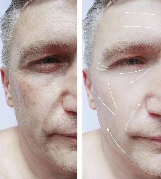 Male Face Wrinkles Procedures — Stock Photo, Image