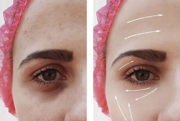 美丽的女孩脸皱纹之前和之后的程序 — 图库照片
