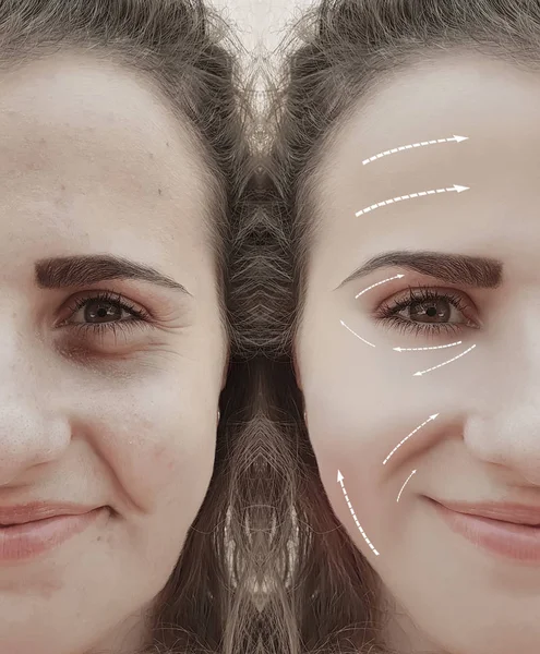 Beautiful Girl Face Wrinkles Procedures Arrow — Stock Photo, Image