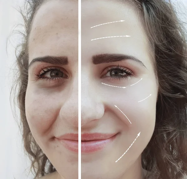 美丽的女孩脸皱纹之前和之后的程序 — 图库照片