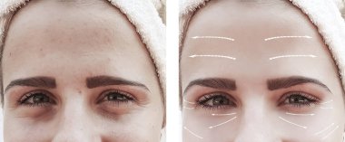 güzel kız kırışıklıklar yüzünde öncesi ve sonrası yordamları yüz