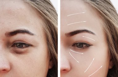 yüz güzel kız yüz kırışıklıklar önce ve yordamlar sonra ok