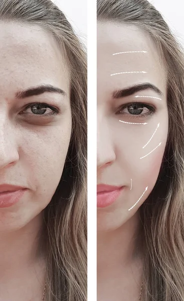 Face Beautiful Girl Face Wrinkles Procedures Arrow — Stock Photo, Image