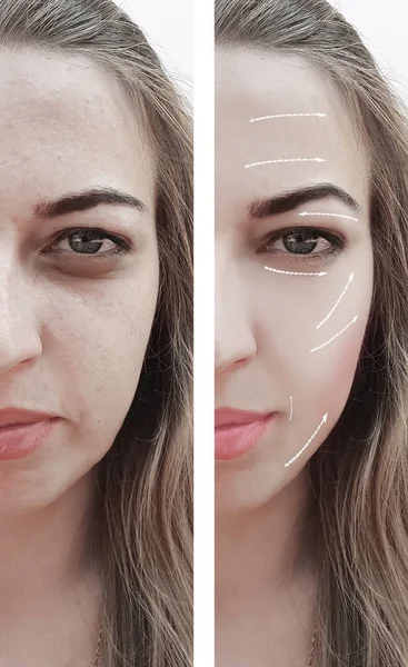 Cara Linda Menina Rosto Rugas Antes Depois Procedimentos Seta — Fotografia de Stock