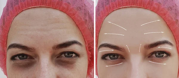 Cara Linda Menina Rosto Rugas Antes Depois Procedimentos Seta — Fotografia de Stock