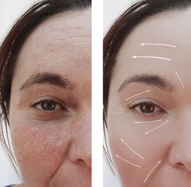 yüz yüz kadın kırışıklıkları önce ve yordamlar sonra ok