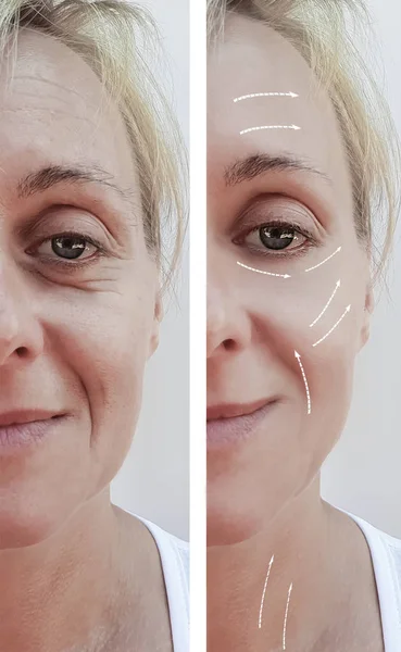 Arrugas Faciales Femeninas Antes Después Los Procedimientos Cosméticos Flecha — Foto de Stock