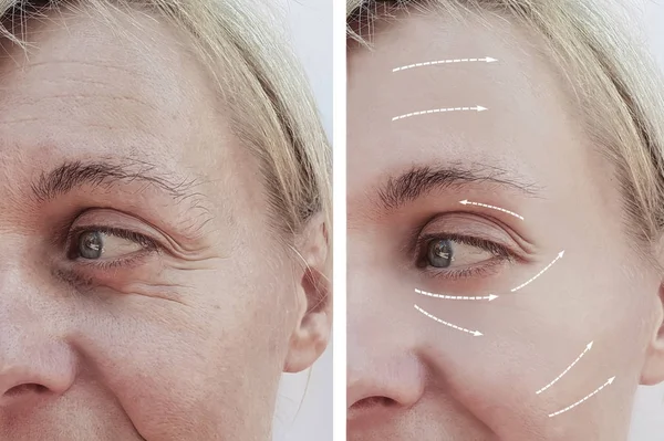 Riduri Faciale Feminine Înainte După Proceduri Cosmetice Săgeată — Fotografie, imagine de stoc