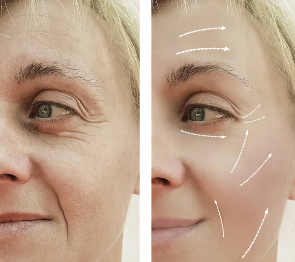 Arrugas Faciales Femeninas Antes Después Los Procedimientos Cosméticos Flecha — Foto de Stock