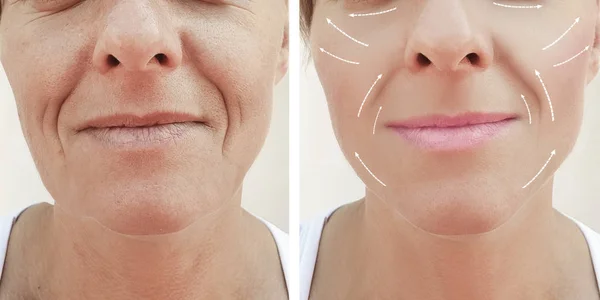 女性面部皱纹之前和之后整容手术 — 图库照片