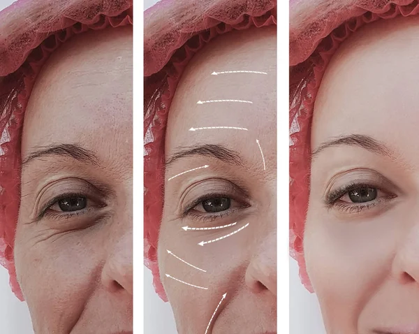 female facial wrinkles before and after cosmetic procedures, arrow