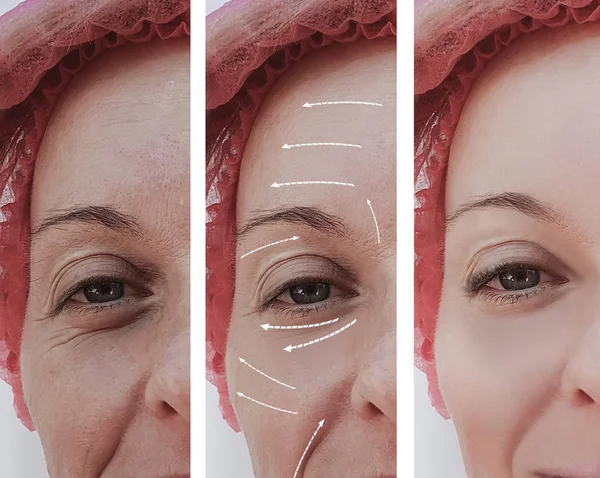 Rugas Faciais Femininas Antes Depois Procedimentos Cosméticos Seta — Fotografia de Stock