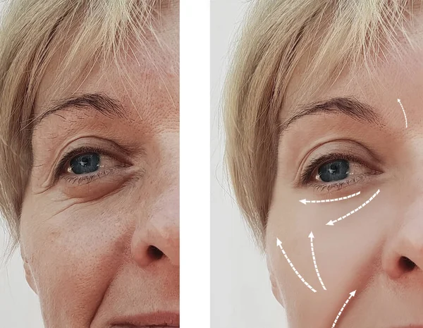 Female Facial Wrinkles Cosmetic Procedures Arrow — Stock Photo, Image