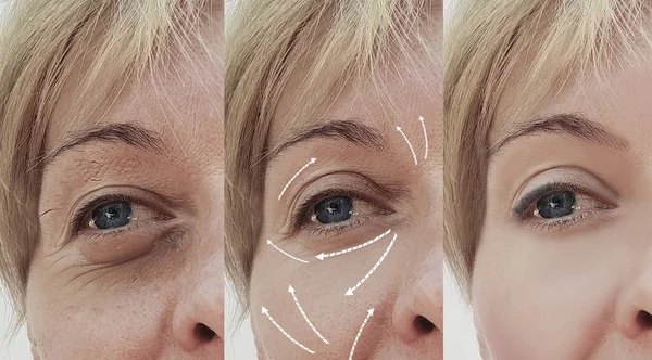 female facial wrinkles before and after cosmetic procedures, arrow