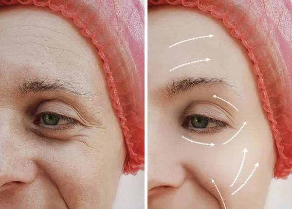 Perempuan Keriput Wajah Sebelum Dan Setelah Prosedur Kosmetik Panah — Stok Foto