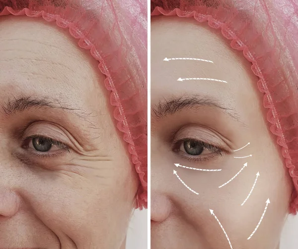 Kvindelige Ansigtsrynker Før Efter Kosmetiske Procedurer Pil - Stock-foto