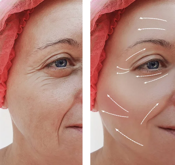 Rugas Faciais Femininas Antes Depois Procedimentos Cosméticos Seta — Fotografia de Stock