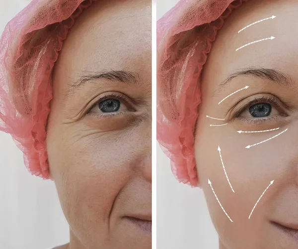 female facial wrinkles before and after cosmetic procedures, arrow