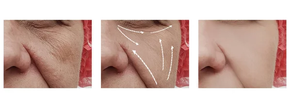 face wrinkles before and after procedures arrow