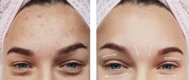 yüz kız kırışıklıklar öncesi ve sonrası yordamları