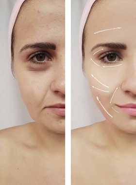 öncesi ve sonrası yordamları kız göz kırışıklıkları yüz