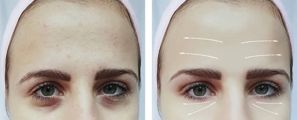 Rosto Menina Olhos Rugas Antes Depois Procedimentos — Fotografia de Stock