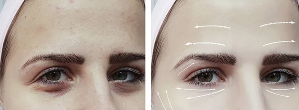 Mata Gadis Wajah Keriput Sebelum Dan Setelah Prosedur — Stok Foto