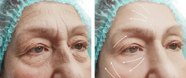 Cara Una Mujer Anciana Con Arrugas Cara Antes Después Los — Foto de Stock