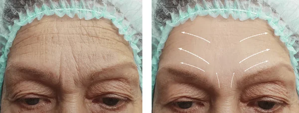 Face Elderly Woman Wrinkles Face Procedures Arrow — Stock Photo, Image