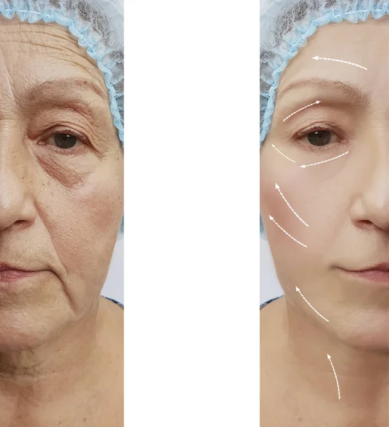 Face Old Woman Wrinkles Procedures Arrow — Stock Photo, Image