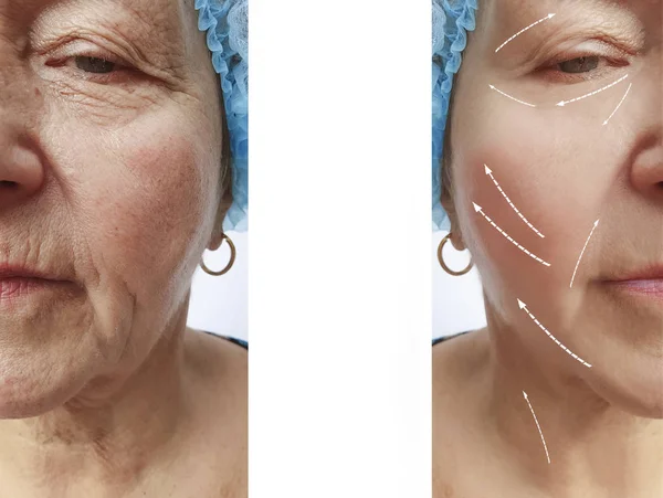 Face Old Woman Wrinkles Procedures Arrow — Stock Photo, Image