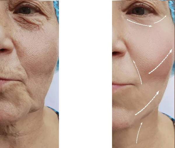 Face Old Woman Wrinkles Procedures Arrow — Stock Photo, Image