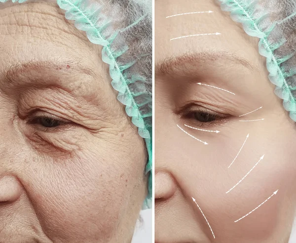 face of an old woman wrinkles before and after procedures arrow