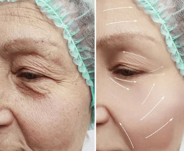 Gesicht Einer Alten Frau Faltet Vor Und Nach Eingriffen Pfeil — Stockfoto