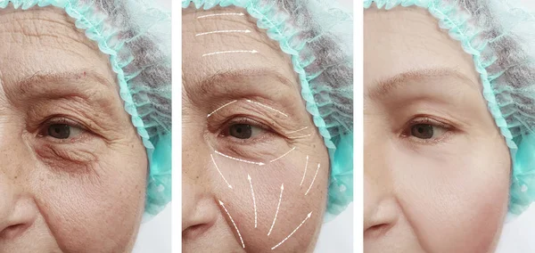 face of an old woman wrinkles before and after procedures arrow