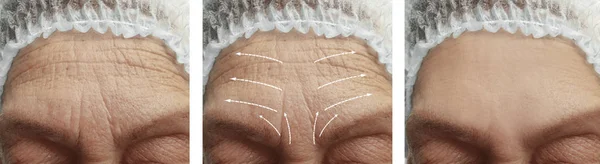 面对一个老女人的皱纹之前和之后的程序箭头 — 图库照片