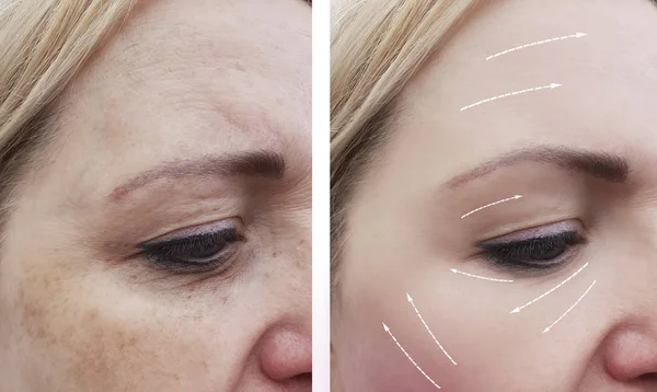 Arrugas Cara Mujer Antes Después Los Procedimientos Flecha —  Fotos de Stock