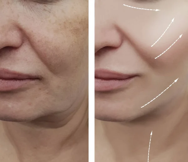 Woman Face Wrinkles Procedures Arrow — Stock Photo, Image